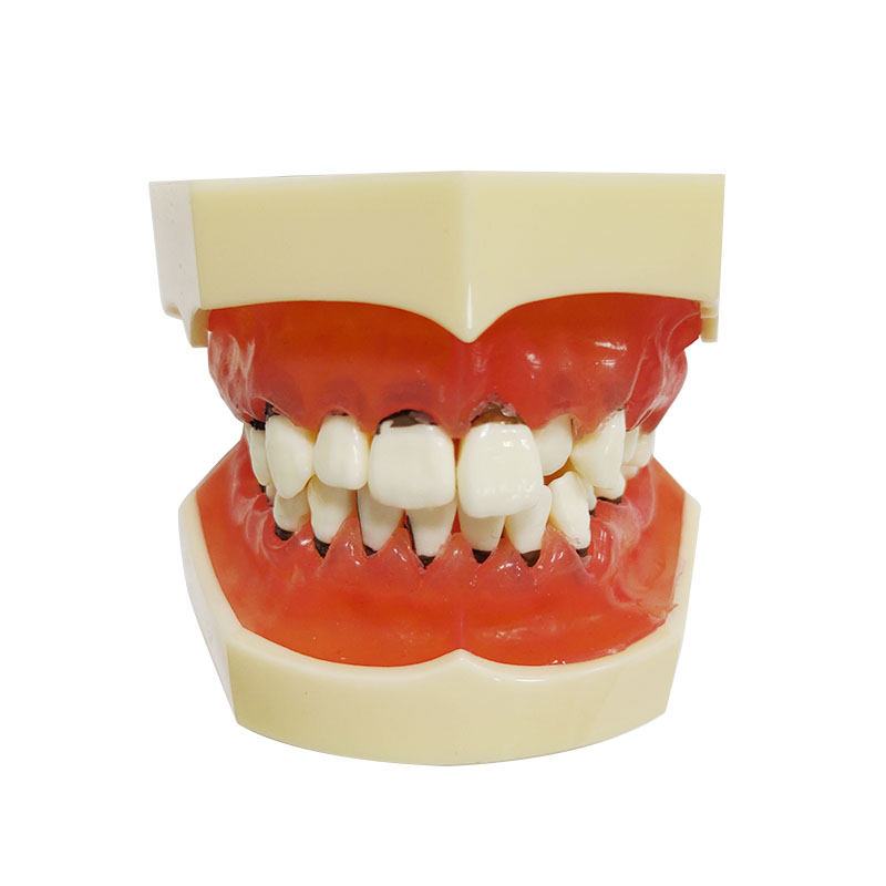 Modelo de enfermedad periodontal UM-4003
   