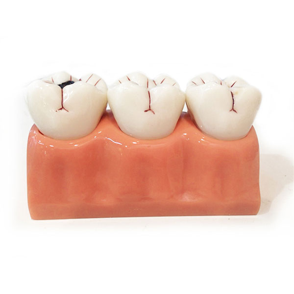 UM-L10 Modelo de desmontaje de caries de tamaño cuádruple
   