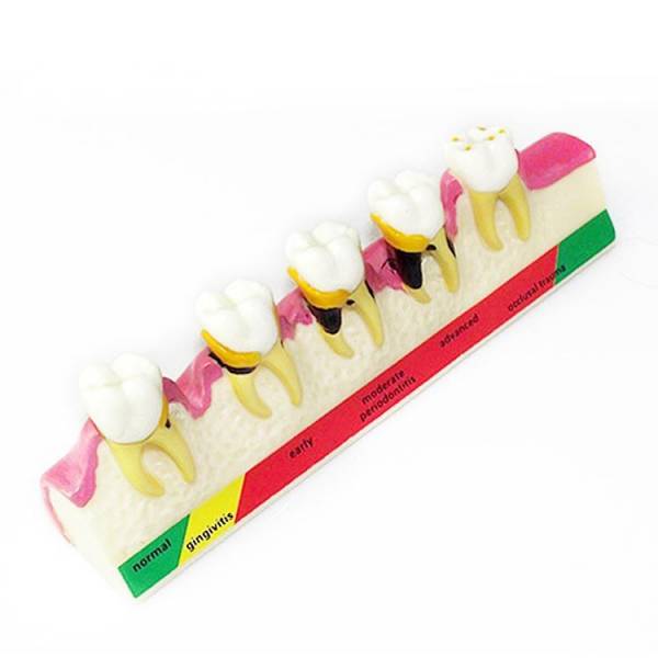 Modelo de clasificación de enfermedades periodontales UM-E9
   