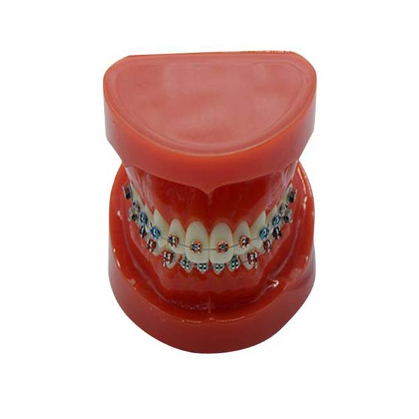 Modelo de estudio UM-B16 con tirantes fijos en los dientes (normal)