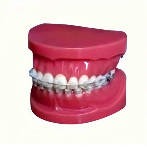 Modelo de estudio UM-B17 con tirantes fijos en los dientes (normal)