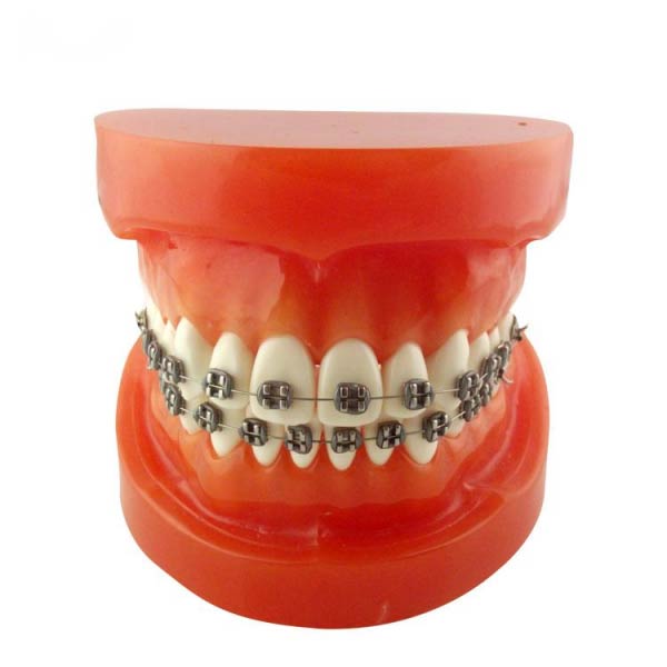 Modelo de ortodoncia UM-B9 (soportes metálicos)
