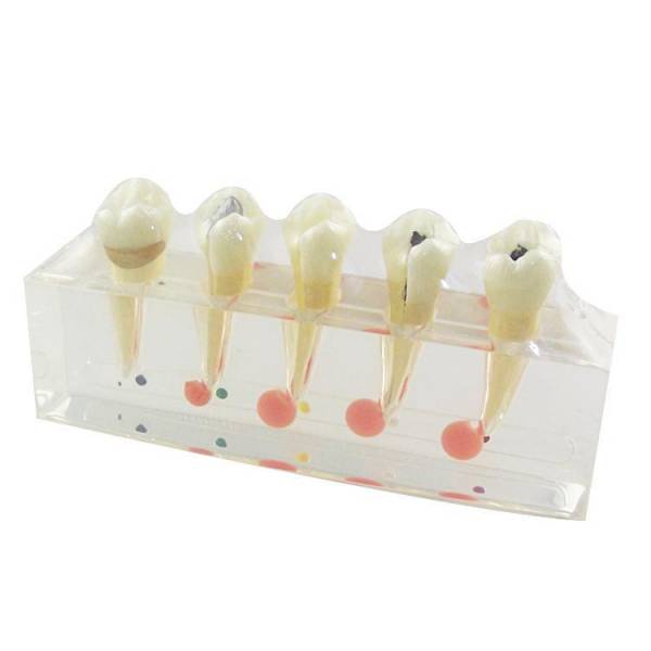 UM-L3A modelo clínico de enfermedad dental y de la pulpa dental